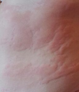 Hives started on the torso.